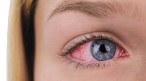 Alergia Ocular
