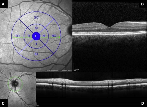 Novo Exame de Vista Poderia Prever Alzheimer